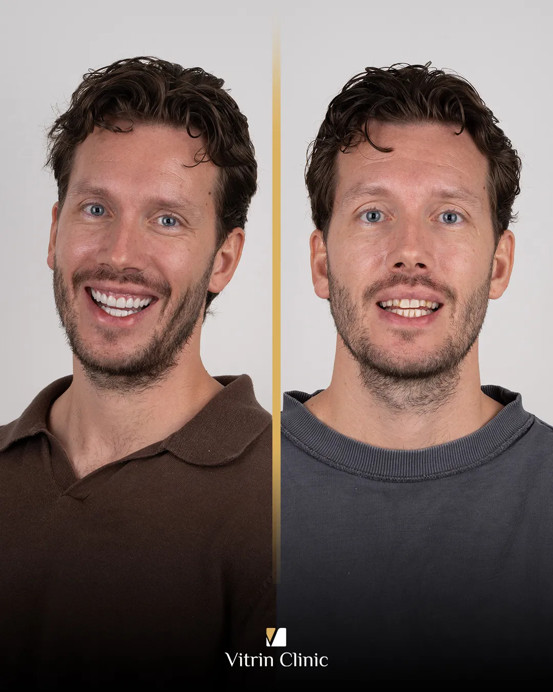 Faccette per denti gialli